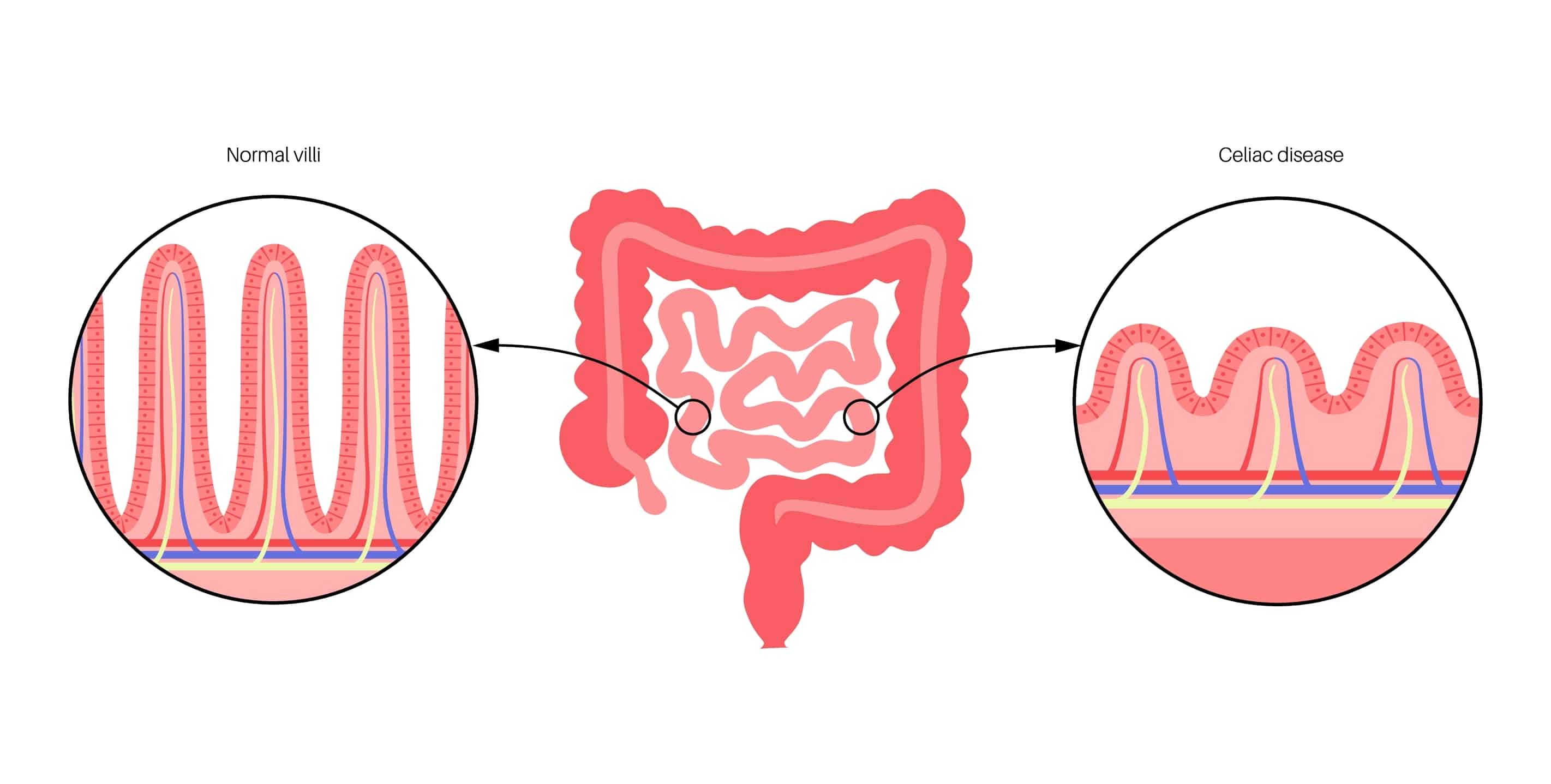 Featured image for “Transglutaminas IgA”